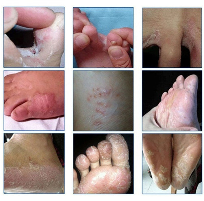 10pcs/lot  Fungal Infections Foot Bath Powder Feet Care Athlete's Foot, Foot Odor, Sweat, Itching, Peeling, Beriberi
