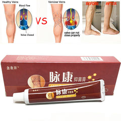 Chinese Natural Herbal Medicine for Varicose Veins Ointment Vasculitis Inflammation Leg Massage Varicose Veins Cream