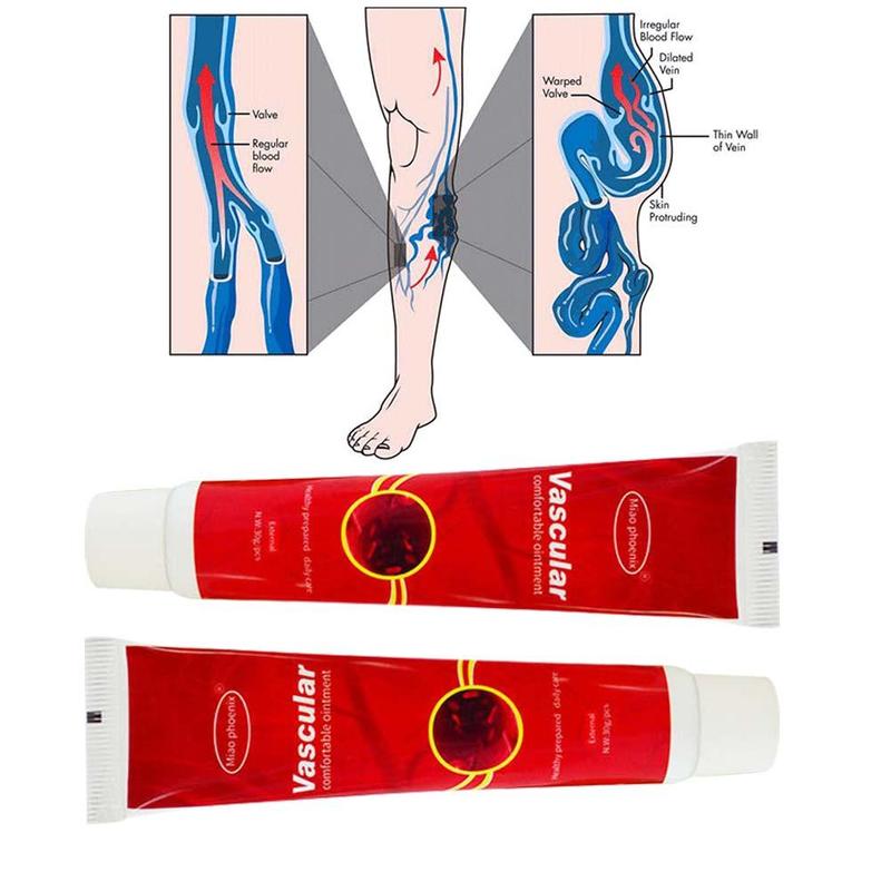 Varicose Veins Treatment Cream Ointment Vasculitis Phlebitis Spider Veins Pain Varicosity Angiitis Remedy Removal Herbal Cream